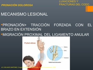 LUXACIONES Y
FRACTURAS DEL CODO
MECANISMO LESIONAL
PRONACIÓN+ TRACCIÓN FORZADA CON EL
BRAZO EN EXTENSIÓN
MIGRACIÓN PROXIMAL DEL LIGAMENTO ANULAR
PRONACIÓN DOLOROSA
A.D. DELGADO MARTINEZ. Cirugía Ortopédica y Traumatología. Madrid: Panamericana, 2009.
 