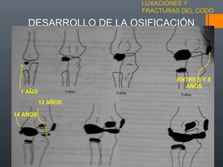 LUXACIONES Y
FRACTURAS DEL CODO
DESARROLLO DE LA OSIFICACIÓN
1 AÑO
14 AÑOS
12 AÑOS
ENTRE 5 Y 8
AÑOS
 