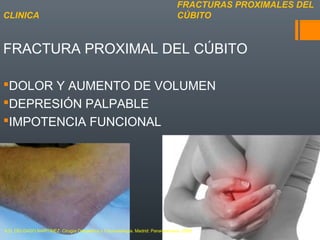 FRACTURA PROXIMAL DEL CÚBITO
DOLOR Y AUMENTO DE VOLUMEN
DEPRESIÓN PALPABLE
IMPOTENCIA FUNCIONAL
FRACTURAS PROXIMALES DEL
CÚBITOCLINICA
A.D. DELGADO MARTINEZ. Cirugía Ortopédica y Traumatología. Madrid: Panamericana, 2009.
 