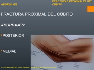 FRACTURA PROXIMAL DEL CÚBITO
ABORDAJES:
POSTERIOR
MEDIAL
FRACTURAS PROXIMALES DEL
CÚBITOABORDAJES
A.D. DELGADO MARTINEZ. Cirugía Ortopédica y Traumatología. Madrid: Panamericana, 2009.
 