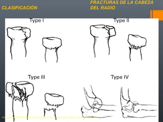 FRACTURAS DE LA CABEZA
DEL RADIOCLASIFICACIÓN
A.D. DELGADO MARTINEZ. Cirugía Ortopédica y Traumatología. Madrid: Panamericana, 2009.
 