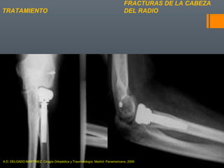 FRACTURAS DE LA CABEZA
DEL RADIOTRATAMIENTO
A.D. DELGADO MARTINEZ. Cirugía Ortopédica y Traumatología. Madrid: Panamericana, 2009.
 
