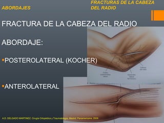 FRACTURA DE LA CABEZA DEL RADIO
ABORDAJE:
POSTEROLATERAL (KOCHER)
ANTEROLATERAL
FRACTURAS DE LA CABEZA
DEL RADIOABORDAJES
A.D. DELGADO MARTINEZ. Cirugía Ortopédica y Traumatología. Madrid: Panamericana, 2009.
 