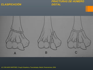 FRACTURAS DE HÚMERO
DISTALCLASIFICACIÓN
A.D. DELGADO MARTINEZ. Cirugía Ortopédica y Traumatología. Madrid: Panamericana, 2009.
 