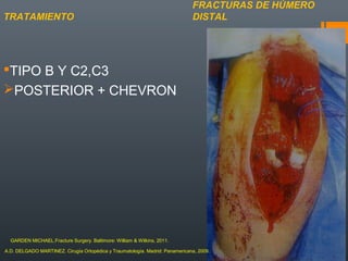 TIPO B Y C2,C3
POSTERIOR + CHEVRON
FRACTURAS DE HÚMERO
DISTALTRATAMIENTO
A.D. DELGADO MARTINEZ. Cirugía Ortopédica y Traumatología. Madrid: Panamericana, 2009.
GARDEN MICHAEL.Fracture Surgery. Baltimore: William & Wilkins, 2011.
 