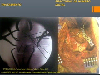 FRACTURAS DE HÚMERO
DISTALTRATAMIENTO
A.D. DELGADO MARTINEZ. Cirugía Ortopédica y Traumatología. Madrid: Panamericana, 2009.
GARDEN MICHAEL.Fracture Surgery. Baltimore: William & Wilkins, 2011.
 