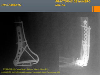 FRACTURAS DE HÚMERO
DISTALTRATAMIENTO
A.D. DELGADO MARTINEZ. Cirugía Ortopédica y Traumatología. Madrid: Panamericana, 2009.
GARDEN MICHAEL.Fracture Surgery. Baltimore: William & Wilkins, 2011.
 
