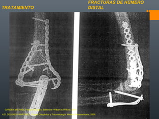 FRACTURAS DE HÚMERO
DISTALTRATAMIENTO
A.D. DELGADO MARTINEZ. Cirugía Ortopédica y Traumatología. Madrid: Panamericana, 2009.
GARDEN MICHAEL.Fracture Surgery. Baltimore: William & Wilkins, 2011.
 