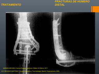 FRACTURAS DE HÚMERO
DISTALTRATAMIENTO
A.D. DELGADO MARTINEZ. Cirugía Ortopédica y Traumatología. Madrid: Panamericana, 2009.
GARDEN MICHAEL.Fracture Surgery. Baltimore: William & Wilkins, 2011.
 