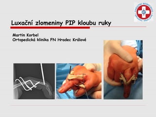 Luxační zlomeniny PIP kloubu ruky
Martin Korbel
Ortopedická klinika FN Hradec Králové
 