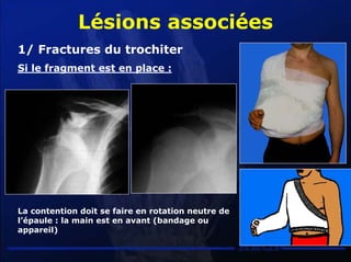 Luxationsepaule | PDF