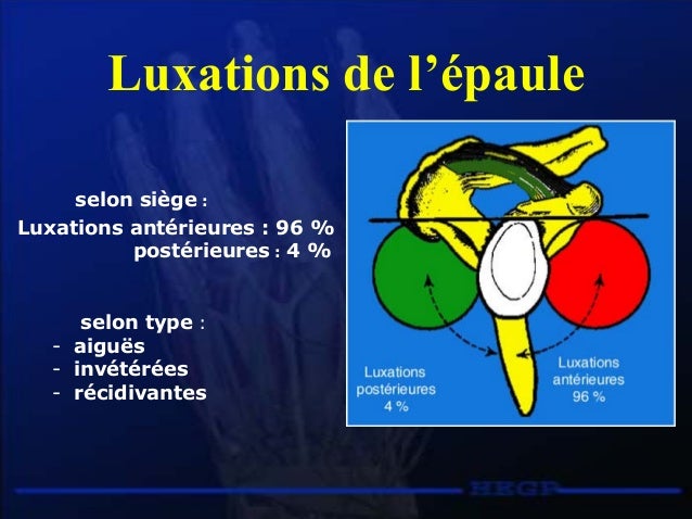 signe-du-berger-paule-instabilit-ant-rieure-de-l-paule