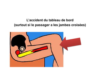 L’accident du tableau de bord 
(surtout si le passager a les jambes croisées) 
 