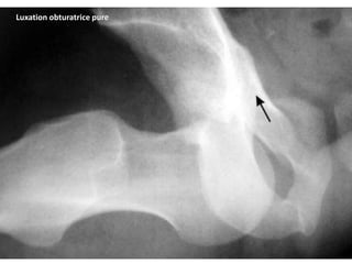 Luxation obturatrice pure 
 