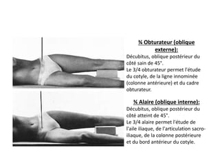 ¾ Obturateur (oblique 
externe): 
Décubitus, oblique postérieur du 
côté sain de 45°. 
Le 3/4 obturateur permet l'étude 
du cotyle, de la ligne innominée 
(colonne antérieure) et du cadre 
obturateur. 
¾ Alaire (oblique interne): 
Décubitus, oblique postérieur du 
côté atteint de 45°. 
Le 3/4 alaire permet l'étude de 
l'aile iliaque, de l'articulation sacro-iliaque, 
de la colonne postérieure 
et du bord antérieur du cotyle. 
 