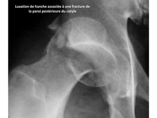 Luxation de hanche associée à une fracture de 
la paroi postérieure du cotyle 
 