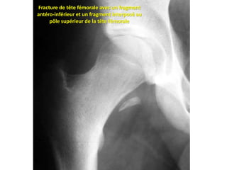 Fracture de tête fémorale avec un fragment 
antéro-inférieur et un fragment interposé au 
pôle supérieur de la tête fémorale 
 