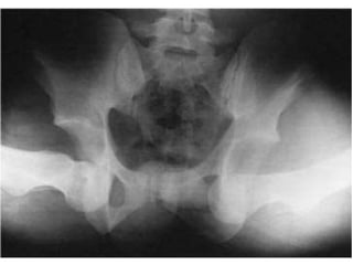 Luxation obturatrice bilatérale 
 