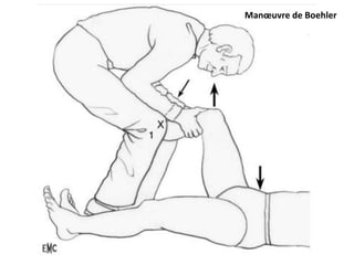 Manoeuvre de Boehler 
 