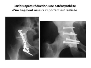 Parfois après réduction une ostéosynthèse 
d’un fragment osseux important est réalisée 
 