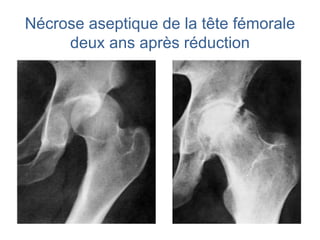 Nécrose aseptique de la tête fémorale 
deux ans après réduction 
 