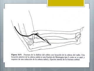 Luxo fractura de monteggia y galeazzi
