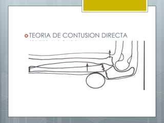  TEORIADE CONTUSION DIRECTA
 (SPEED Y BOYD).
 