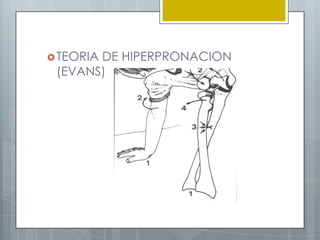  TEORIA
       DE HIPERPRONACION
 (EVANS)
 