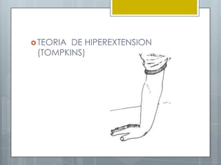  TEORIADE HIPEREXTENSION
 (TOMPKINS)
 