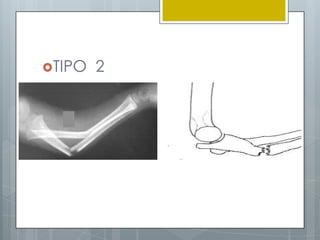 TIPO   2
 
