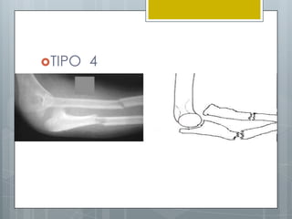 TIPO   4
 