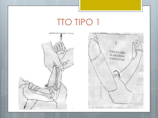 TTO TIPO 1
 