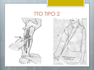 TTO TIPO 2
 