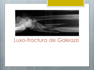 Luxo-fractura de Galeazzi
 