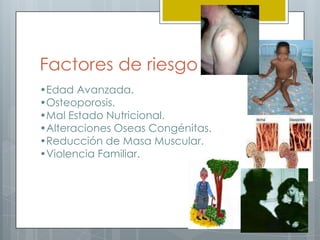 Factores de riesgo
•Edad Avanzada.
•Osteoporosis.
•Mal Estado Nutricional.
•Alteraciones Oseas Congénitas.
•Reducción de Masa Muscular.
•Violencia Familiar.
 