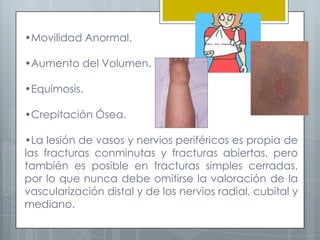 •Movilidad Anormal.

•Aumento del Volumen.

•Equimosis.

•Crepitación Ósea.

•La lesión de vasos y nervios periféricos es propia de
las fracturas conminutas y fracturas abiertas, pero
también es posible en fracturas simples cerradas,
por lo que nunca debe omitirse la valoración de la
vascularización distal y de los nervios radial, cubital y
mediano.
 