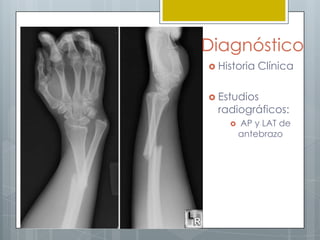 Diagnóstico
 Historia   Clínica

 Estudios
  radiográficos:
       AP y LAT de
        antebrazo
 