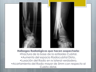 Hallazgos Radiológicos que hacen sospecharla:
      •Fractura de la base de la estiloides Cubital.
       •Aumento del espacio Radiocubital Dista.,
      •Luxación del Radio en rx lateral verdadero.
•Acortamiento del Radio mayor de 5mm con respecto al
                      Cubito distal.
 