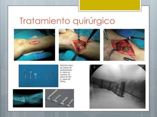 Tratamiento quirúrgico
 
