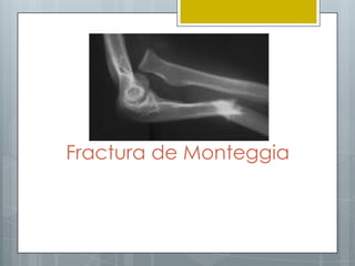 Fractura de Monteggia
 