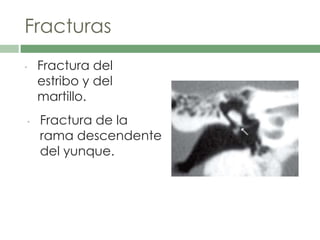 Fracturas
• Fractura del
estribo y del
martillo.
• Fractura de la
rama descendente
del yunque.
 