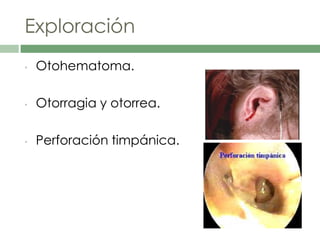 Exploración
• Otohematoma.
• Otorragia y otorrea.
• Perforación timpánica.
 