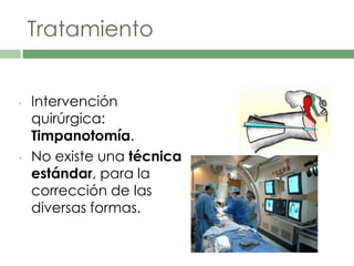 Tratamiento
• Intervención
quirúrgica:
Timpanotomía.
• No existe una técnica
estándar, para la
corrección de las
diversas formas.
 