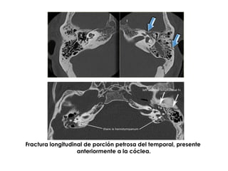 Fractura longitudinal de porción petrosa del temporal, presente
anteriormente a la cóclea.
 