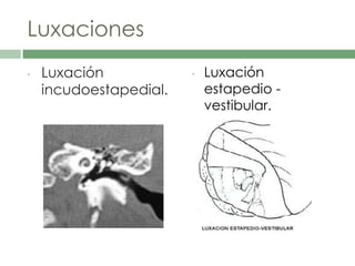 Luxaciones
• Luxación
incudoestapedial.
• Luxación
estapedio -
vestibular.
 
