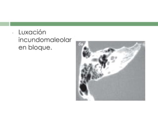 • Luxación
incundomaleolar
en bloque.
 