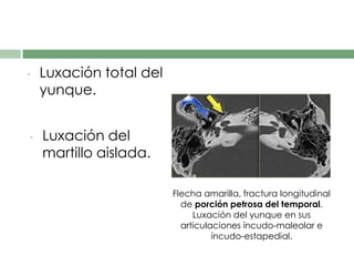 • Luxación total del
yunque.
• Luxación del
martillo aislada.
Flecha amarilla, fractura longitudinal
de porción petrosa del temporal.
Luxación del yunque en sus
articulaciones íncudo-maleolar e
íncudo-estapedial.
 