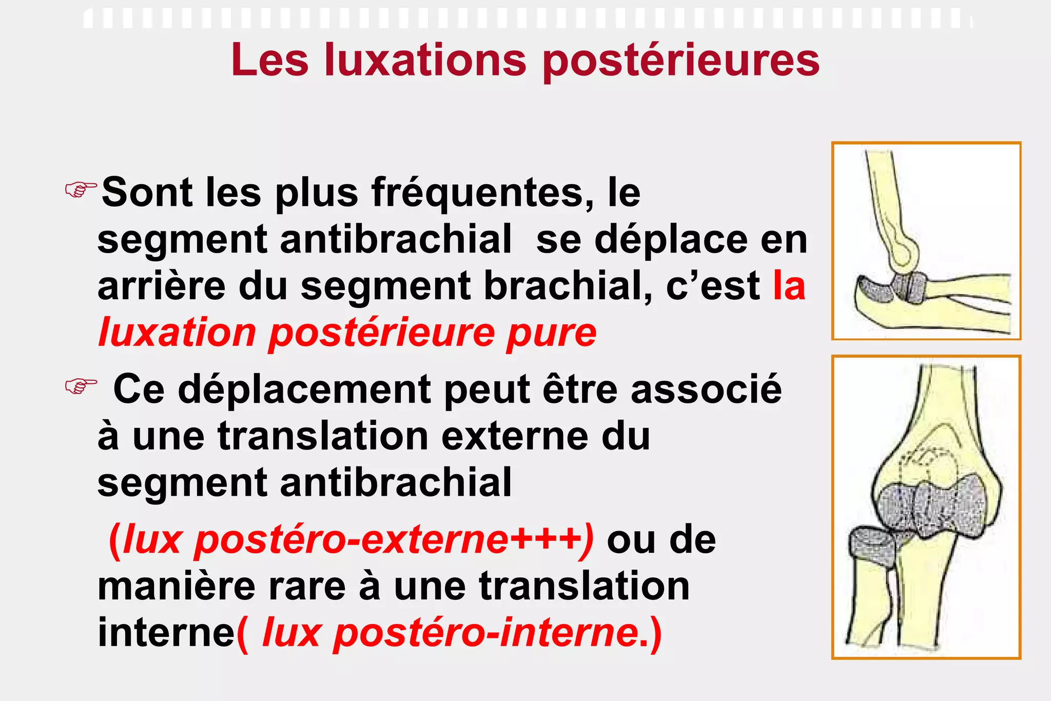 Les luxations postérieures Sont les plus fréquentes, le segment antibrachial  se déplace en arrière du segment brachial, c’est  la  luxation postérieure pure   Ce déplacement peut être associé à une translation externe du segment antibrachial ( lux postéro-externe+++)  ou de manière rare à une translation interne (  lux postéro-interne .) 
