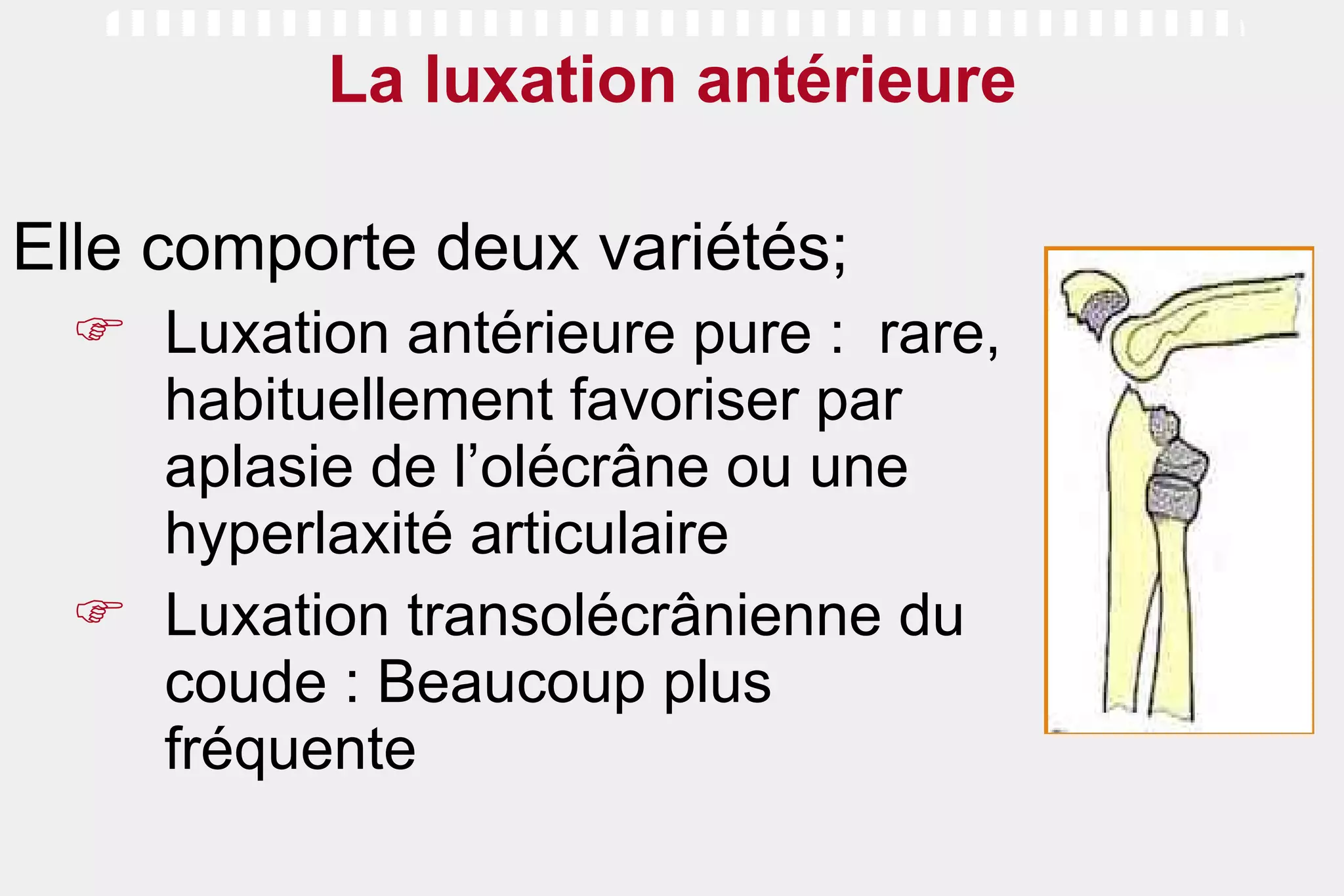 La luxation antérieure Elle comporte deux variétés; Luxation antérieure pure :  rare, habituellement favoriser par aplasie de l’olécrâne ou une hyperlaxité articulaire Luxation transolécrânienne du coude : Beaucoup plus fréquente  
