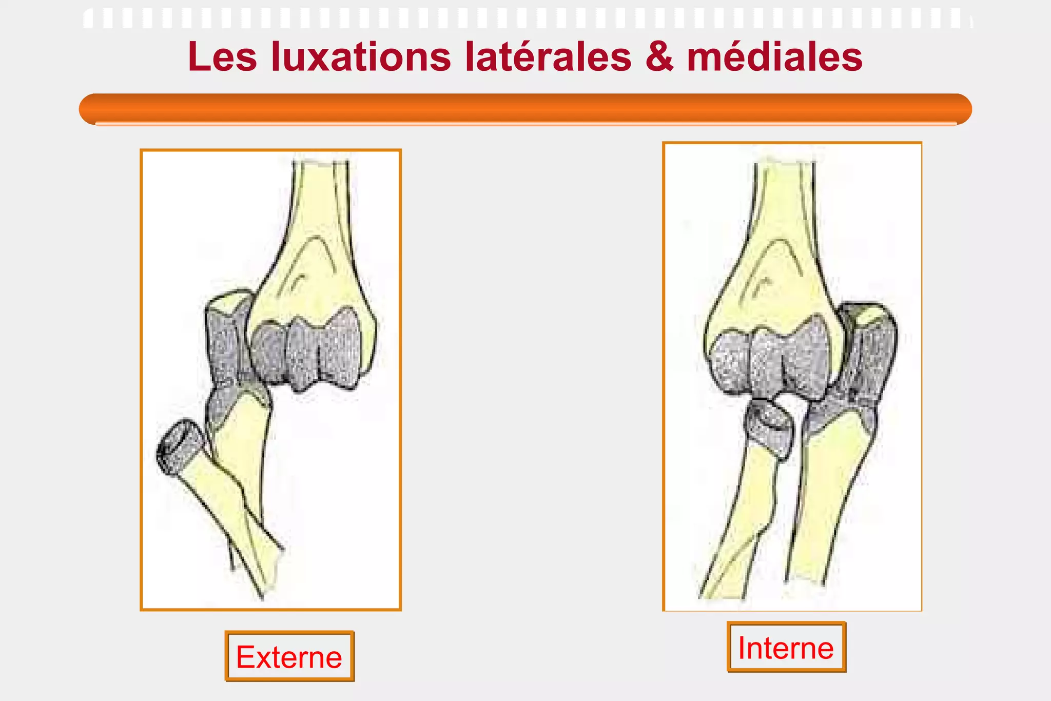 Les luxations latérales & médiales Interne Externe 